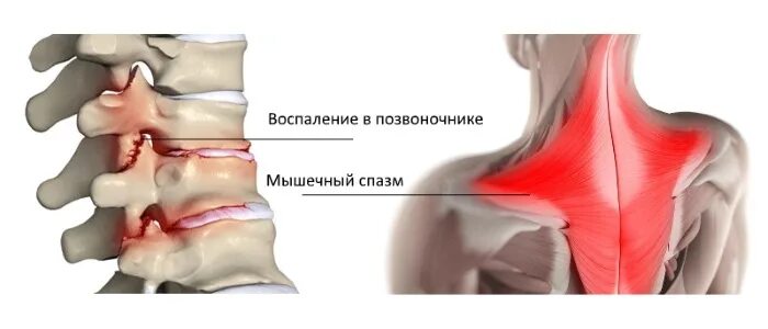 Дорсалгия лечение. Дорсалгия грудного отдела позвоночника. Дорсалгия шейного отдела позвоночника. Дорсалгия поясничного отдела позвоночника. Вертеброгенная дорсалгия поясничного отдела.