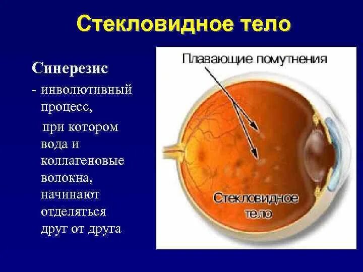 Синерезис стекловидного тела. Ультраструктура стекловидного тела. Плавающие помутнения в стекловидном теле. Помутнение стекловидного тела. Прозрачное тело в глазу