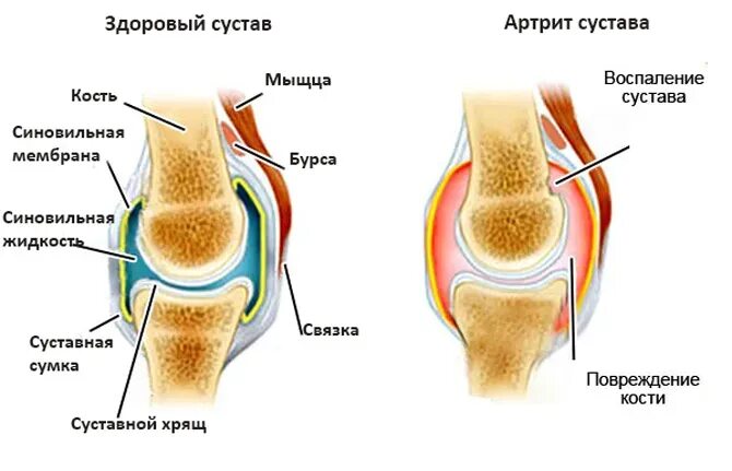 Гудят колени причины. Гипертрофия Гоффа коленного сустава. Суставная капсула коленного сустава воспаление. Отёк коленного стустава.