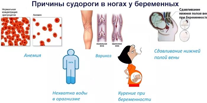 Почему у беременных сводит. Судороги у беременных во 2 триместре причины. Судороги в ногах при беременности. Судороги в ногах у беременных 3 триместр.