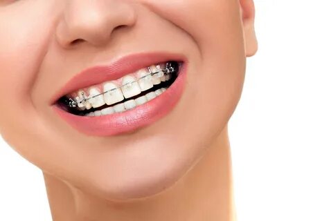 Retainer Instructions - Smile Suffolk Braces Suffolk, VA Orthodontist.