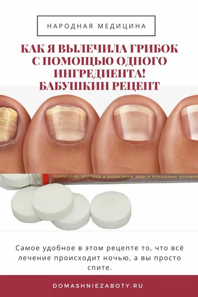 Эффективное лечение грибка ногтей рук. Обработка грибковых ногтей. Грибок ногтей на ногах на ногах.