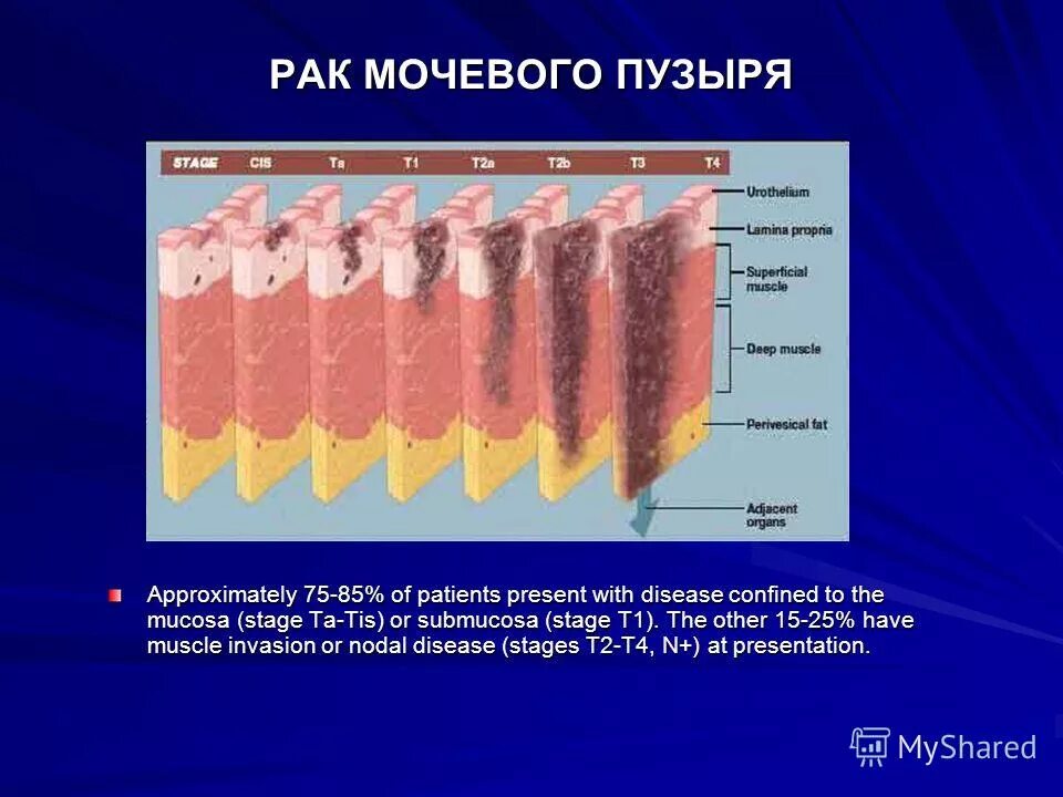 Опухоли мочевого пузыря классификация. Опухоли мочевого пузыря презентация. Опухоль мочевого пузыря т3. Рецидивные опухоли мочевого пузыря. Рак мочевого отзывы