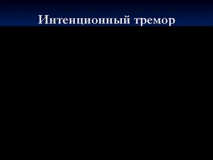 Интенционное дрожание
