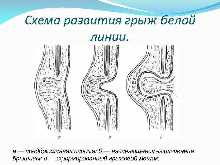 Симптомы грыжи живота у женщин слева