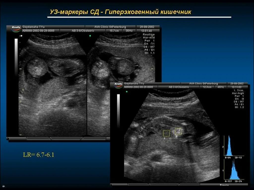 Уз маркеры. УЗИ маркеры хромосомной патологии. Диабетическая фетопатия по УЗИ. Диабетическая фетопатия УЗИ признаки. Ультразвуковые маркеры хромосомных аномалий плода.