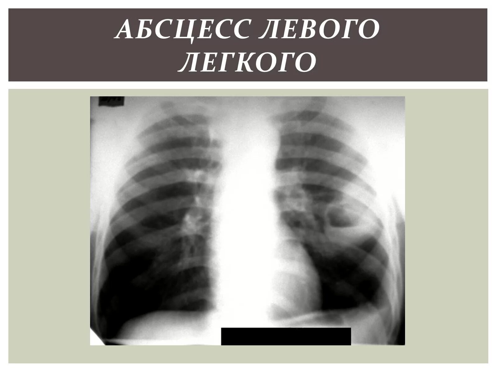 После абсцесса легкого. Абсцесс легкого рентгенограмма. Абсцесс в легком рентген. Рентгенограмма при абсцессе легкого. Рентгенография при абсцессе легкого.