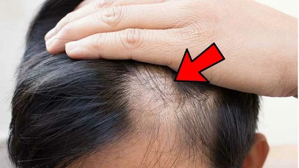 Истончение волос у женщин. Причина сильного выпадения