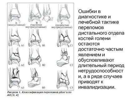 Перелом лодыжки код по мкб 10