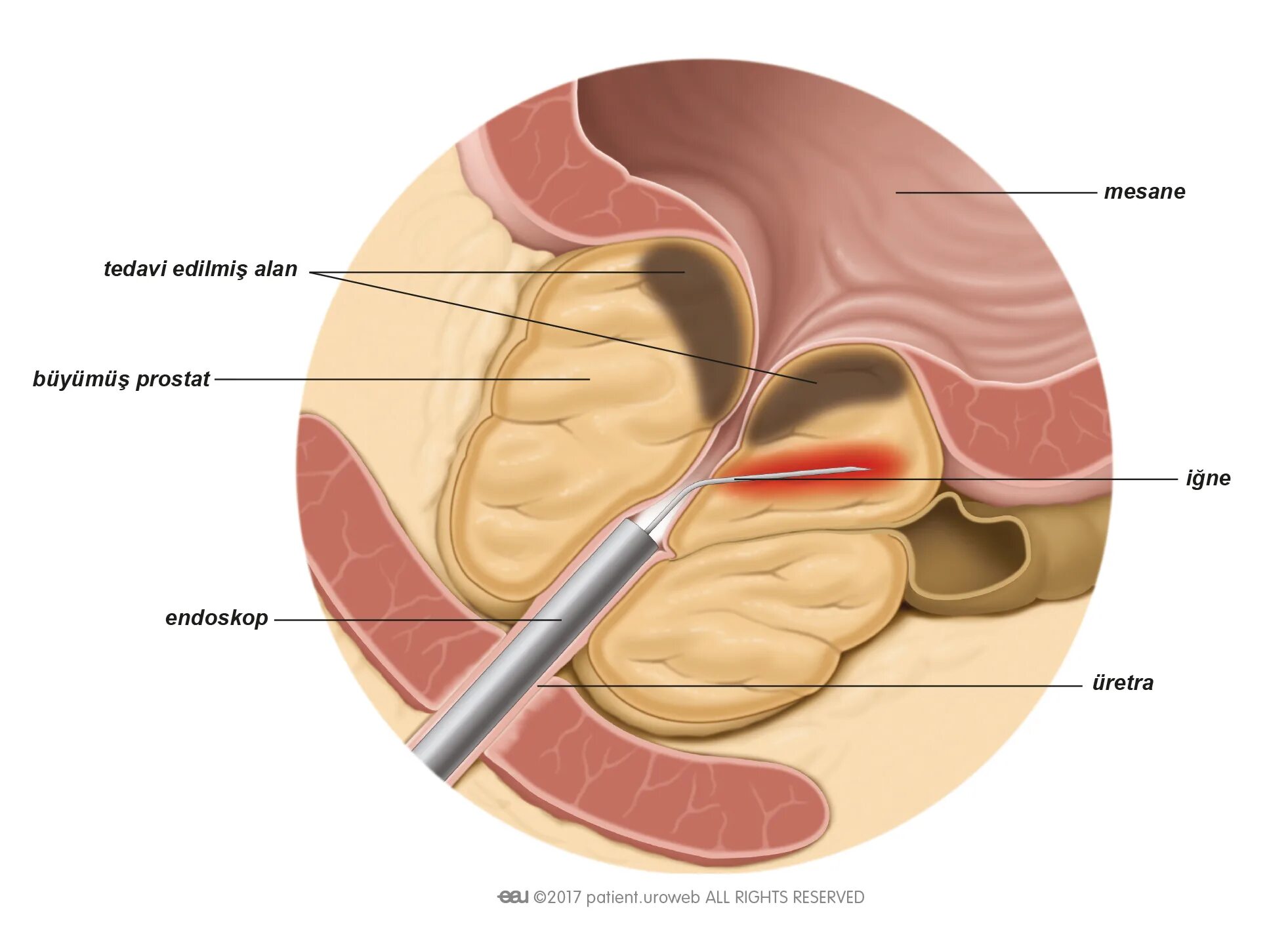 Простата восстанавливается. Энуклеация аденомы предстательной железы. Трансуретральная инцизия. Лазерная абляция предстательной железы. Трансуретральная игольчатая абляция предстательной железы.
