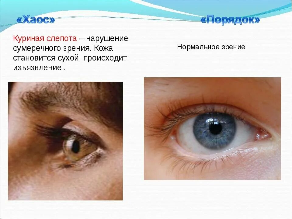 Нарушение сумеречного зрения («куриная слепота»). Гемералопия (куриная слепота). Куриная слепота заболевание глаз.