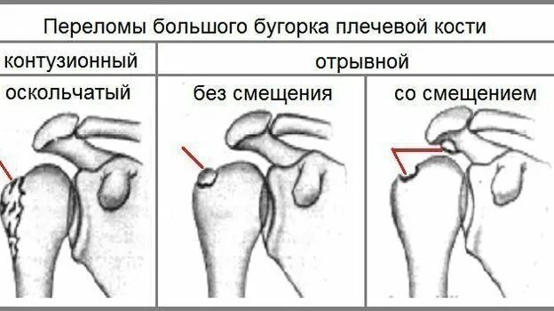 Оскольчатый перелом большого бугорка плечевой кости со смещением. Перелом большого бугорка левой плечевой кости без смещения. Перелом большого бугра плечевой кости без смещения рентген. Оскольчатый перелом бугорка плечевой кости.