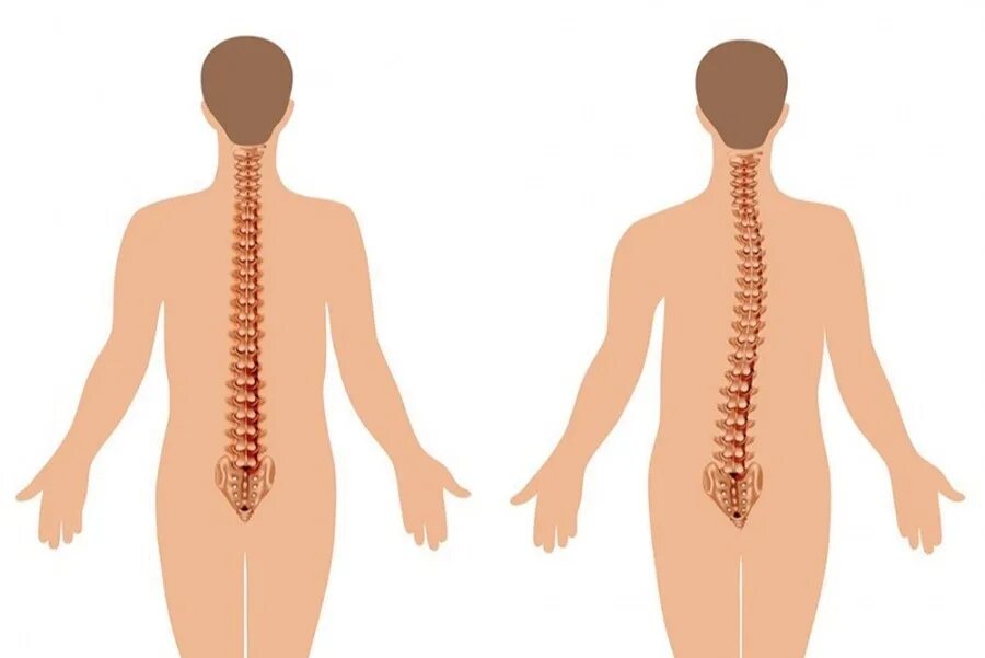 Нормальная поясница. Сколиоз позвоночника th1 th6. Нормальный позвоночник и сколиоз. Сколиоз 1 степени искривления позвоночника. Левосторонний грудной сколиоз 1 степени.