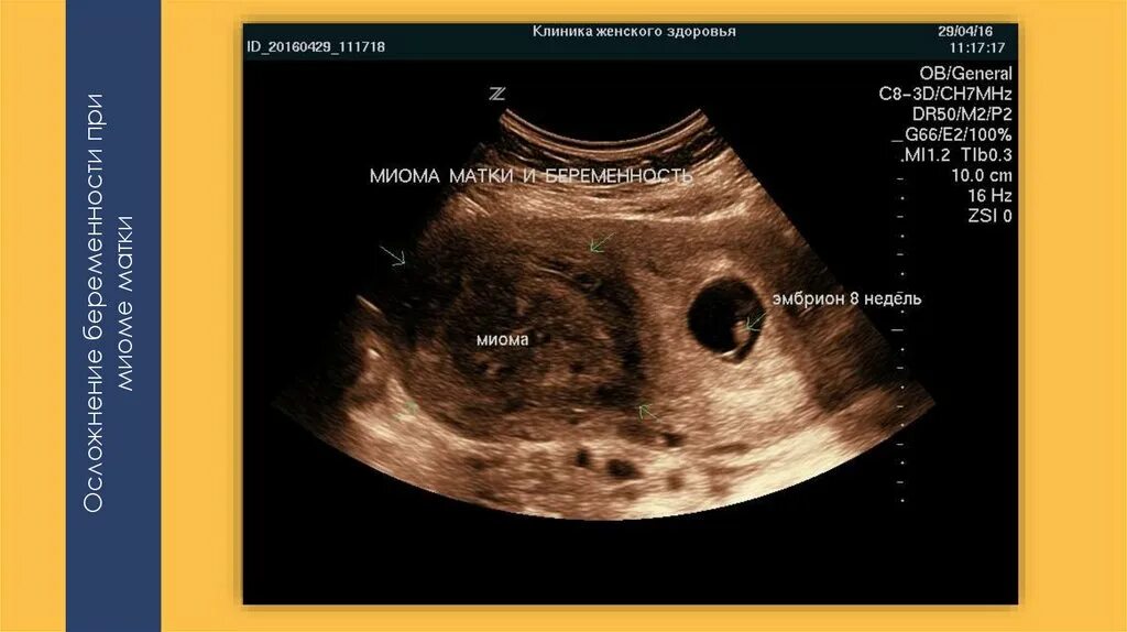 Матка 35 мм. Миома матки и беременность. Миома матки 7-8 недель размер в см.