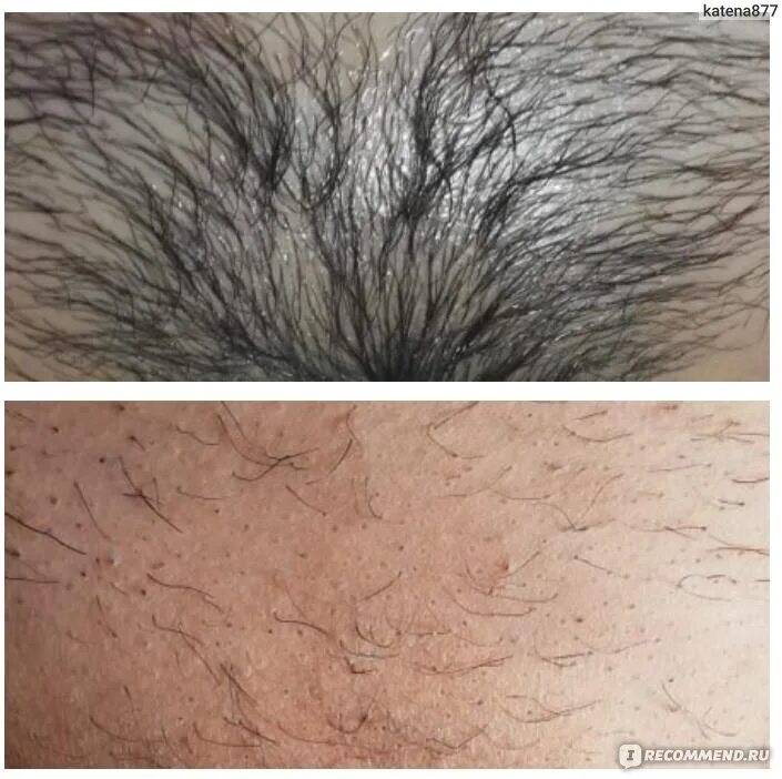 Диодный лазер глубокое бикини. Лазерная эпиляция глубокое бикини. Зона бикини. Александритовый лазер глубокое бикини. Эпиляция бикини отзывы.