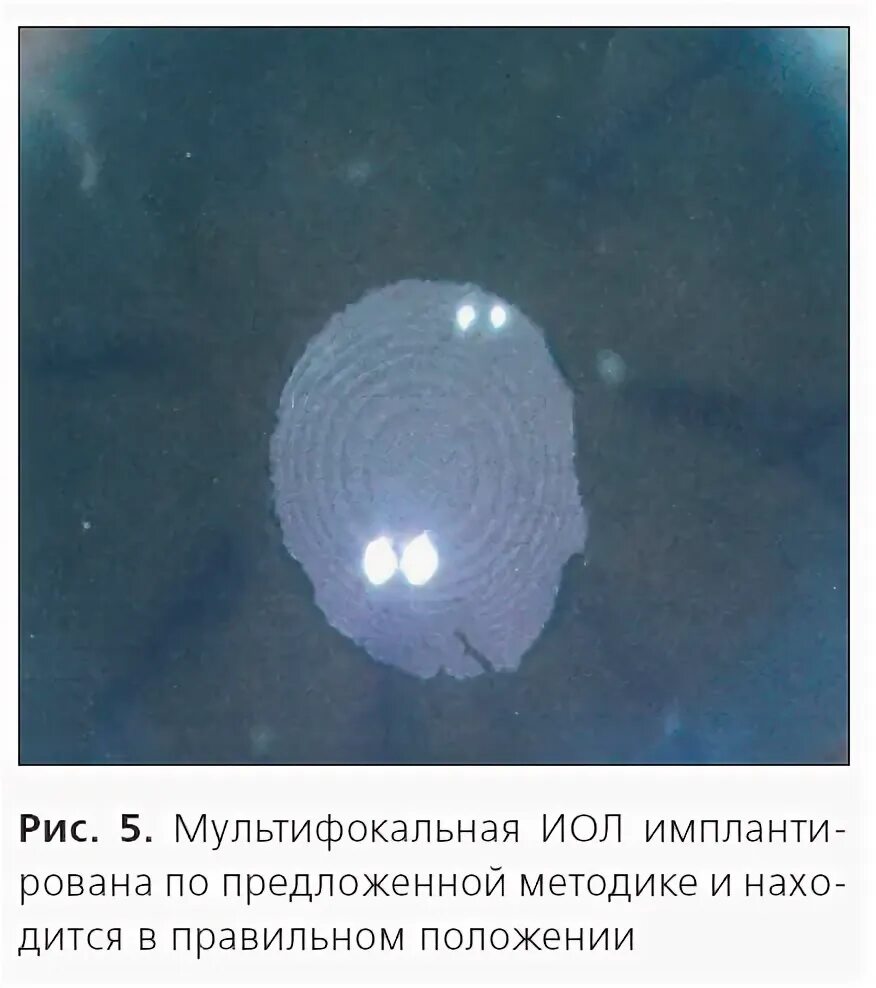 Мультифокальные иол хрусталик. Мультифокальные иол хрусталик