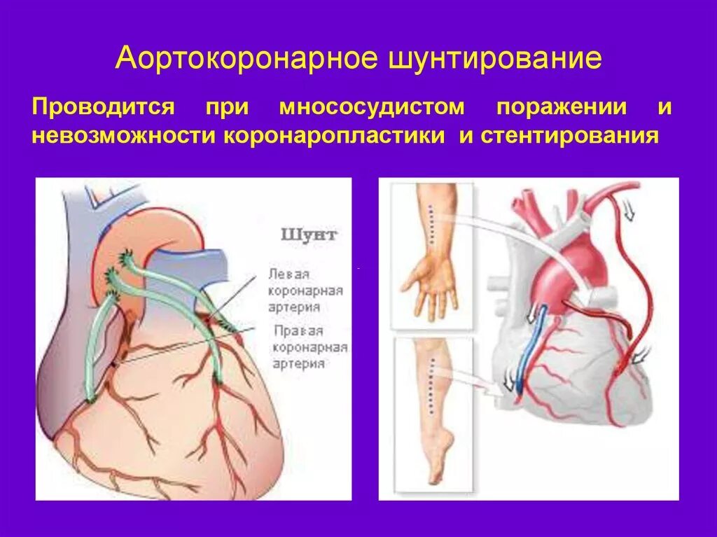 Операции коронарных артерий