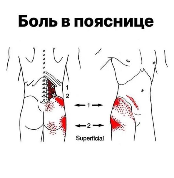 Триггерные точки поясничного отдела. Боль в пояснице триггерные точки. Миофасциальный синдром квадратной мышцы поясницы. Триггерные боли в пояснице. Тт1 триггерная точка.