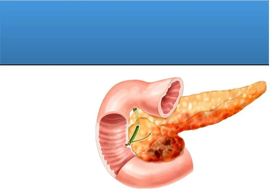 Фиброзные изменения поджелудочной