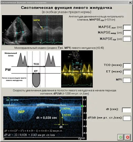 Эхо левого желудочка