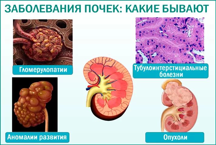 Почки заболевания почек. Причины почечных заболеваний