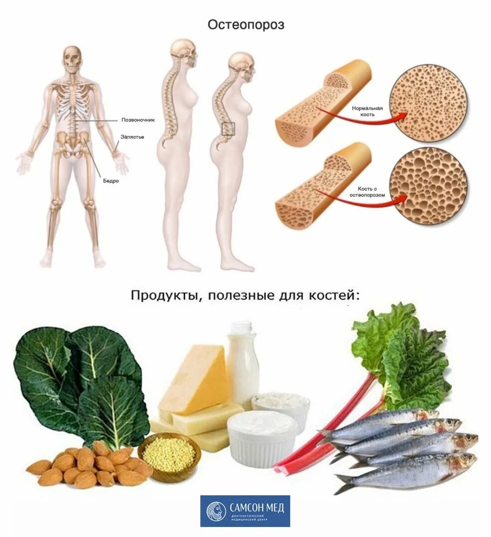 Кости можно есть. Профилактика остеопороза. Продукты полезные для костей. Полезная еда для костей. Остеопороз продукты.