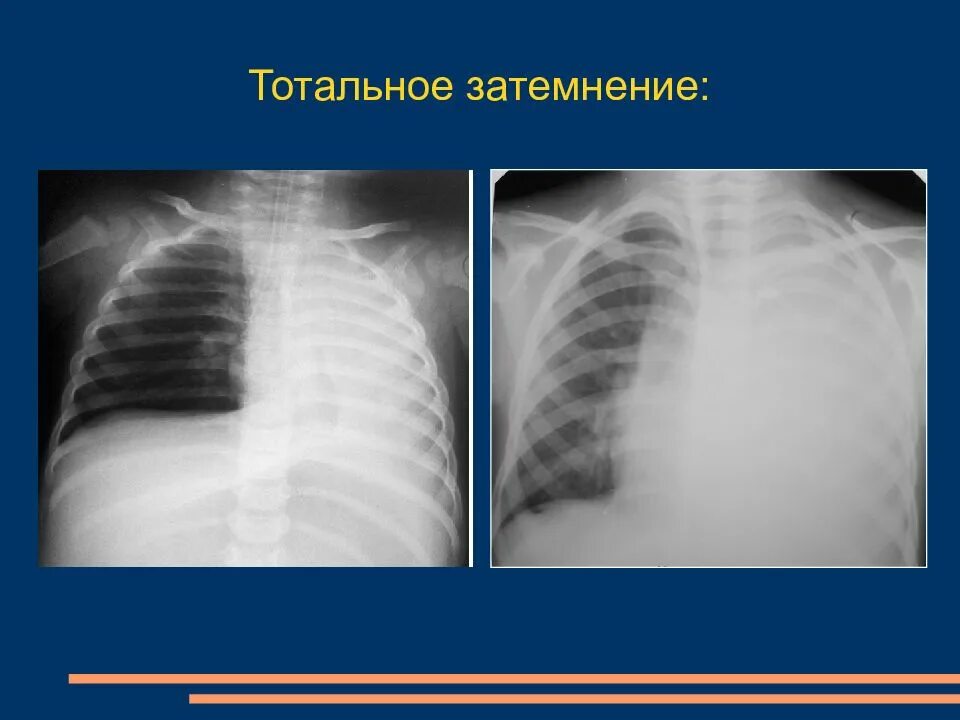Затемнение верхней доли легкого рентген. Субтотальное затемнение легкого рентген. Затемнение легкого диагноз. Затемнение легкого диагноз. Обширное затемнение легкого.