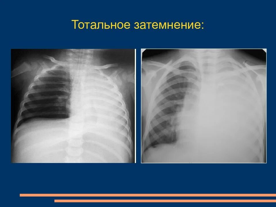 Округлое затемнение. Тотальный ателектаз легкого на рентгене. Тотальный ателектаз рентген. Рентген тотальное затемнение легкого. Тотальное затемнение на рентгене легких.