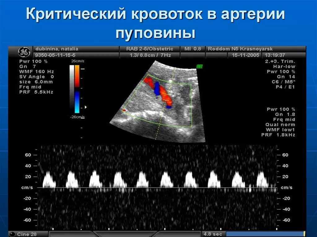 Сма плода. Критический кровоток в артерии пуповины. Нулевой кровоток в пуповине при беременности. Ультразвуковая допплерография маточно-плацентарного кровотока. Норма кровотока допплер плода.