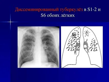 Острый очаговый туберкулез
