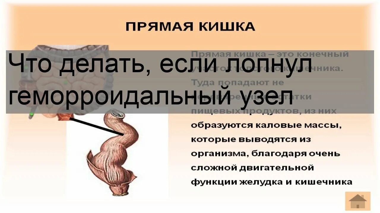 Сильно болит геморрой что делать. Тромбированный узел геморрой. Тромбированный наружный геморроидальный узел. Геморроидальное кровотечение. Геморрой кровотечение.