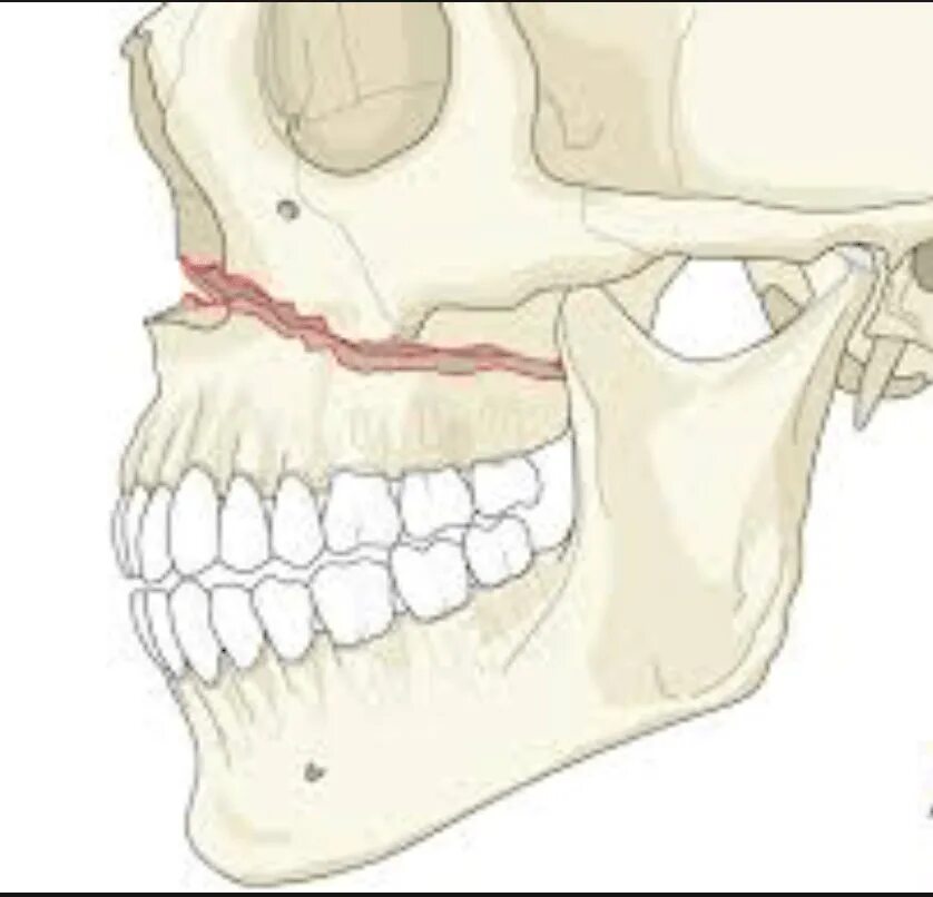 Переломы Лефорт верхней челюсти. Перелом челюсти Лефор 3. Лефор переломы верхней челюсти. Нижняя челюсть с черепом подвижные