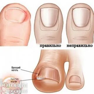Ноготь растет в кожу
