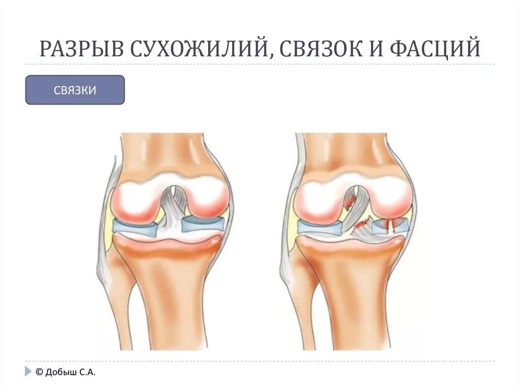 Лигаментоз крестообразных связок. Лигаментит внутренней связки коленного сустава.