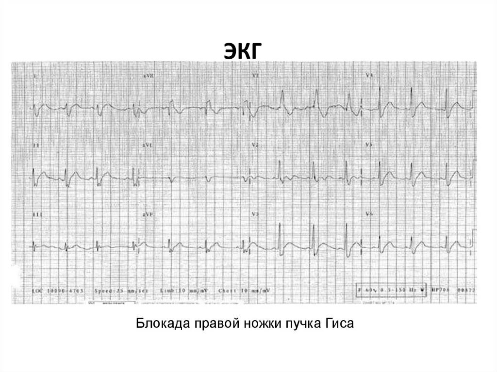 Блокада правого желудочка. Блокада ПНПГ на ЭКГ. Блокада правой ножки пучка Гиса на ЭКГ. Блокада ножек пучка Гиса на ЭКГ. Блокада Гиса на ЭКГ.