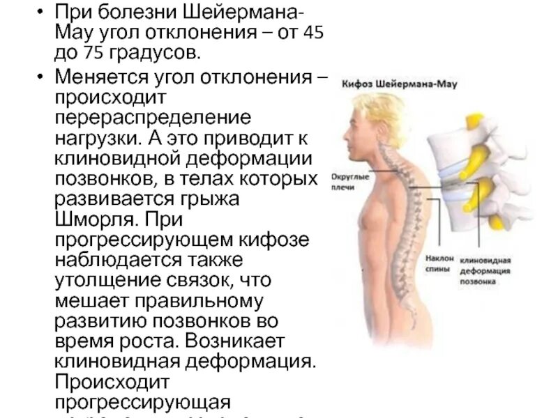 Болезнь шейермана мау что это такое. Физиотерапия при Шейрман МАУ. Болезнь Шейермана МАУ ЛФК. Шейермана МАУ шейный отдел.