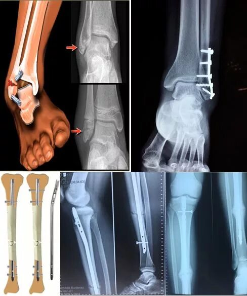 После операции на берцовой кости. Внутрикостный остеосинтез штифт. Остеосинтез малой берцовой Кост. Перелом малоберцовой кости остеосинтез. Осколочный перелом малой берцовой кости.