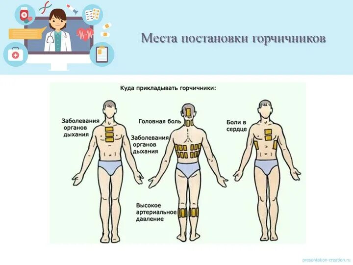 Схема постановки горчичн Ков при бронхите. Схема наложения горчичников при кашле. Места постановки горчичников при бронхите. Схема установки горчичников при кашле. Температура 37 можно ставить горчичники