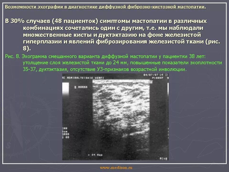 Кистозная мастопатия молочных желез на УЗИ. Фиброзная мастопатия молочной железы на УЗИ. Диффузная фиброзная мастопатия УЗИ. Фиброзная мастопатия молочных желез на УЗИ. Диффузно узловая гиперплазия железы