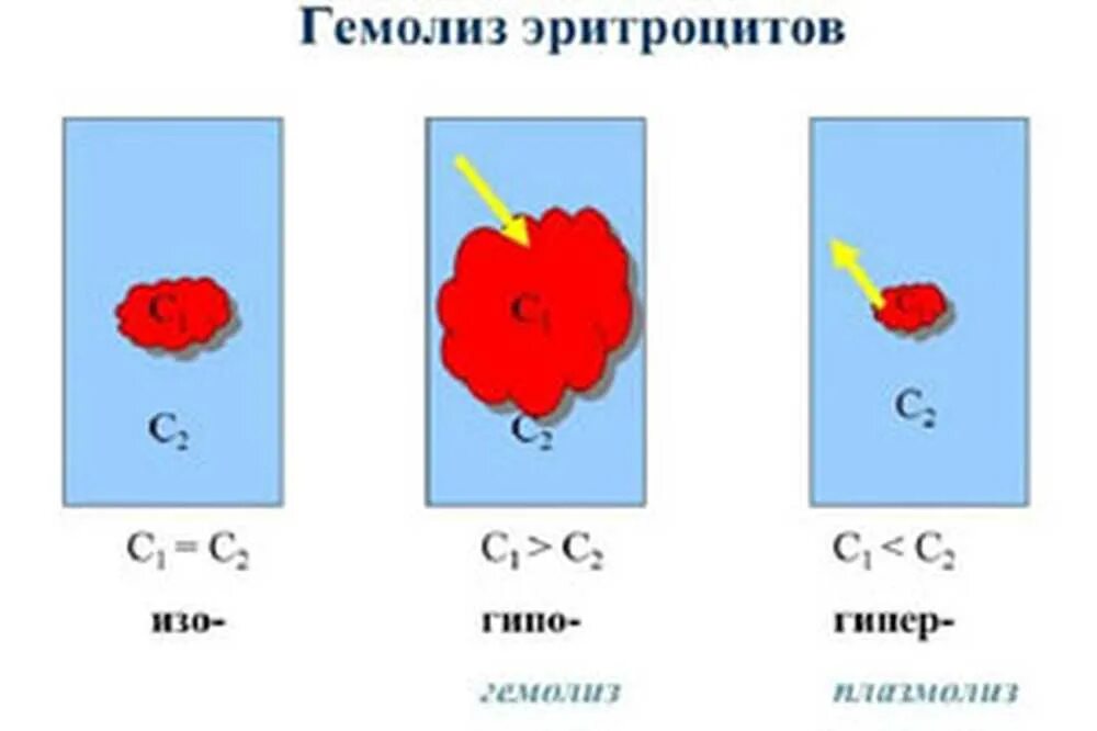 Гемолиз называется. Причины осмотического гемолиза эритроцитов. схема разрушения эритроцитов. гемолиз эритроцитов наступает в растворе. гемолиз эритроцитов в гипертоническом растворе.