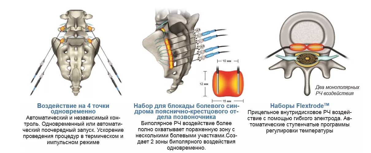 Пояснично крестцовый отдел операция на позвоночнике. Радиочастотная деструкция фасеточных нервов. Радиочастотная абляция фасеточных суставов. Радиочастотная деструкция фасеточных суставов. Радиочастотная денервация фасеточных суставов поясничного отдела.