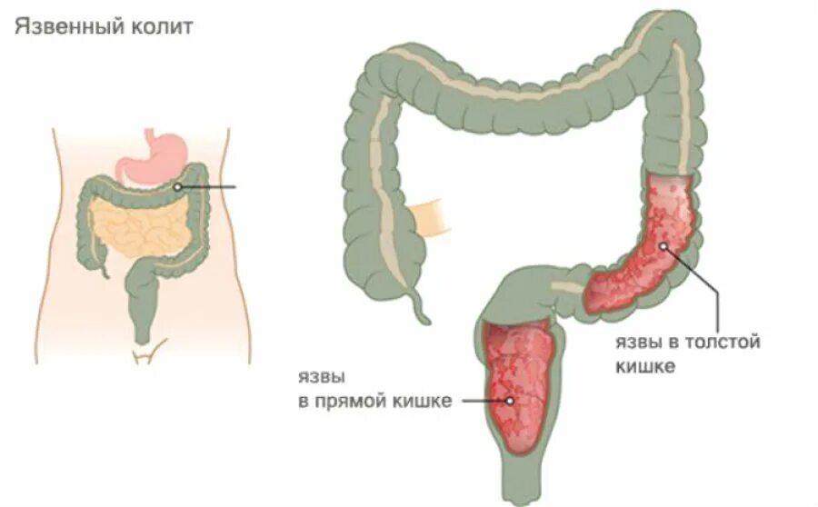 Язвини колить толскишка. Язвенный колит толстой кишки. Язвенный колит двенадцатиперстной кишки. Некротический язвенный колит. Колющая боль в заднем проходе