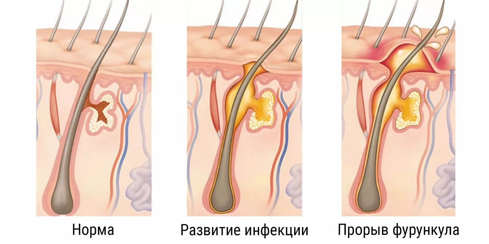 Запах железа носу железы. Абсцедирующий фурункул. Гидраденит дренирование. Фурункулез волосяных фолликулов.