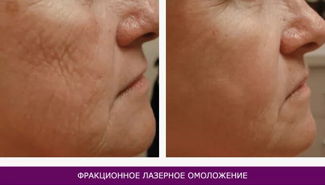 Лазерная шлифовка кожи цена skinlift ru. Со2 лазер фраксель аппарат. Лазерная шлифовка (со2 лазер). Фракционный фототермолиз со2. Лазерная шлифовка рубцов со2.