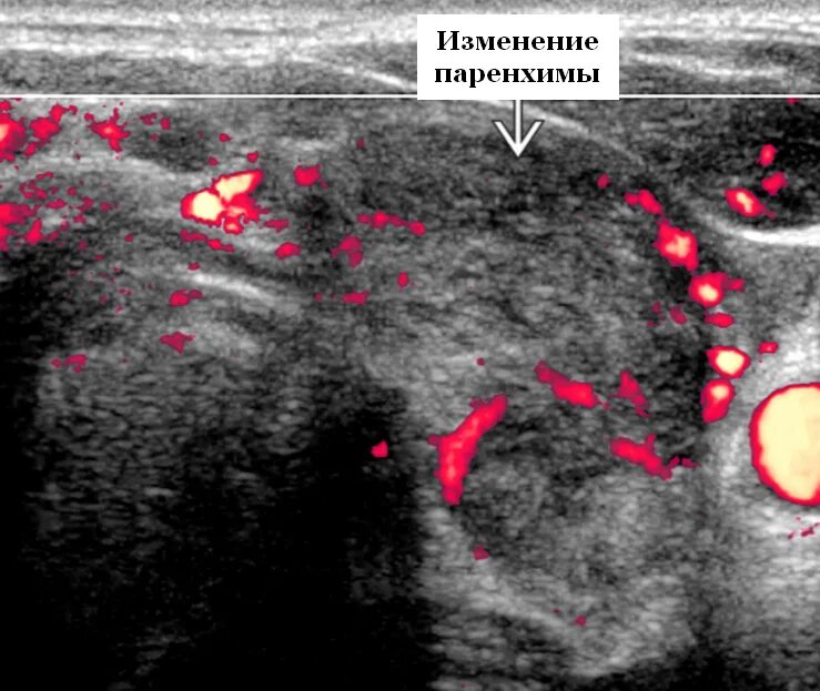 Диффузное изменение щитовидной железы по типу тиреоидита. Подострый тиреоидит на УЗИ. Аутоиммунный тиреоидит УЗИ картина. Диффузный токсический зоб УЗИ. Тиреоидит щитовидной железы на УЗИ.