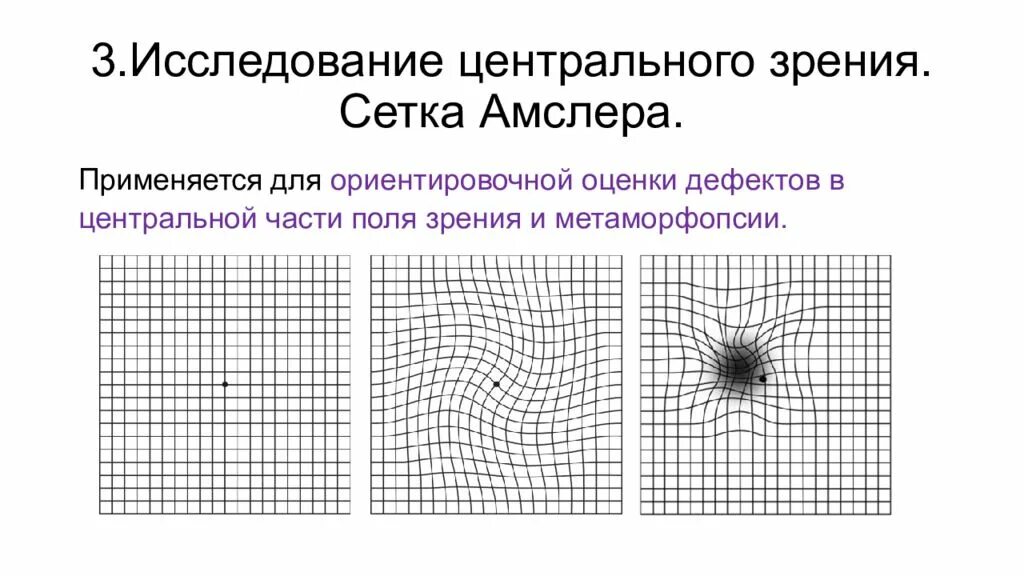 Центральное поле зрения. Сетка Амслера тест. Зрение сетка Амслера. Скотометрия тест Амслера-Маринчева. Тест Амслера при астигматизме.