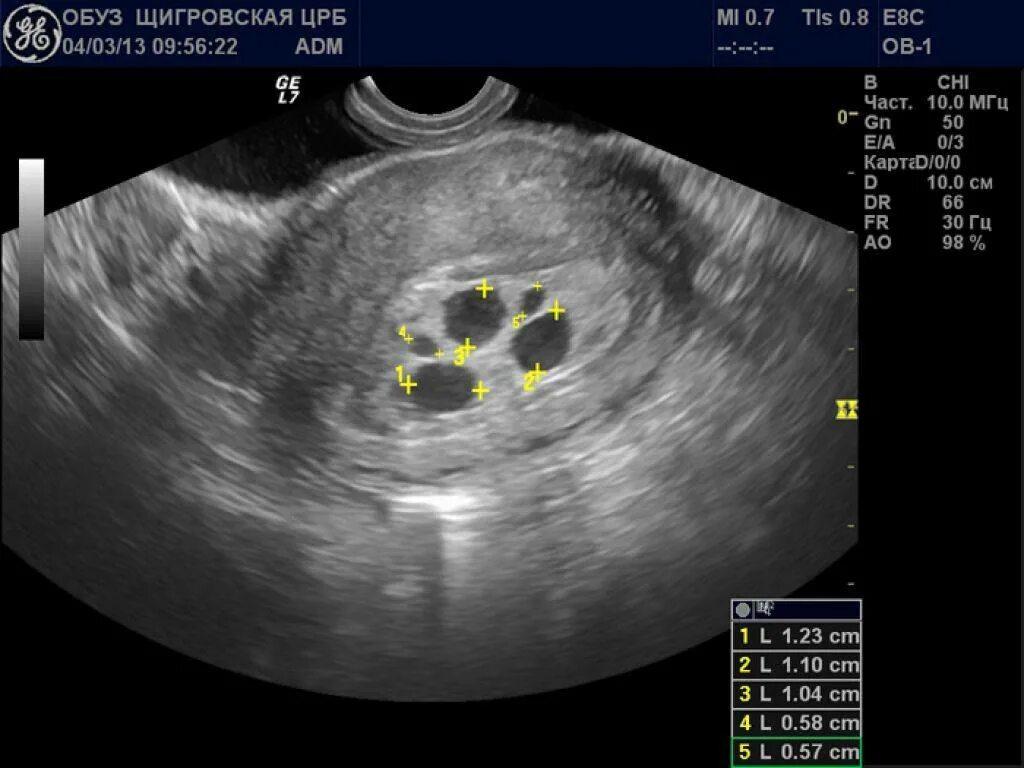 УЗИ признаки маточной беременности. Плодное яйцо 7 недель на УЗИ В матке. Остатки плодного яйца в полости матки УЗИ.
