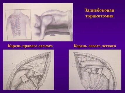 Торакотомия