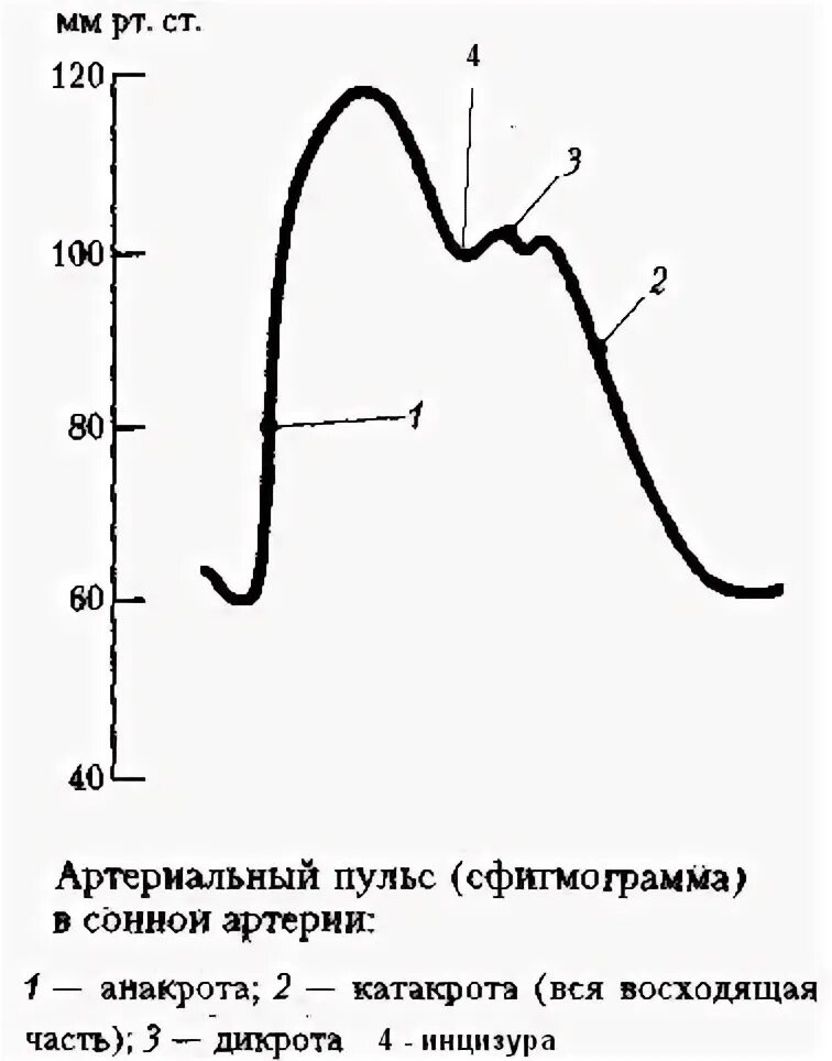 Изменения артериального пульса. Анакрота и катакрота на сфигмограмме. . сфигмограмма сонной артерии в норме. артериальный пульс сфигмограмма. кривая артериального пульса.