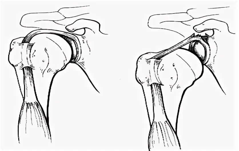 Повреждение губы плечевого сустава. Слап синдром плечевого сустава. Слап повреждение плечевого сустава.